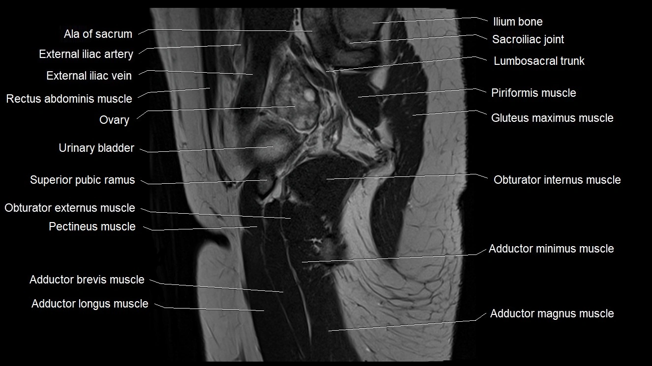 Hip sagittal cross sectional anatomy image 28.webp